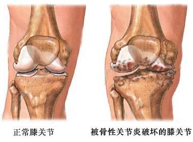 為什么人到中年易患膝骨關節(jié)炎？