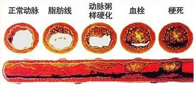血栓在哪，病就在哪！該怎么清除血栓呢？