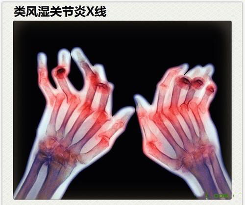 類風(fēng)濕性關(guān)節(jié)炎真的是“不死的癌癥”？