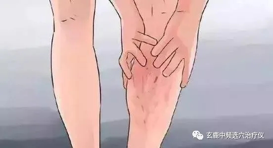 治療靜脈曲張，中醫(yī)有良方，一根針讓你告別“蚯蚓”腿