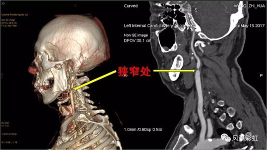 頸椎病都是“積”出來的，4個(gè)傷頸的行為，別總是做